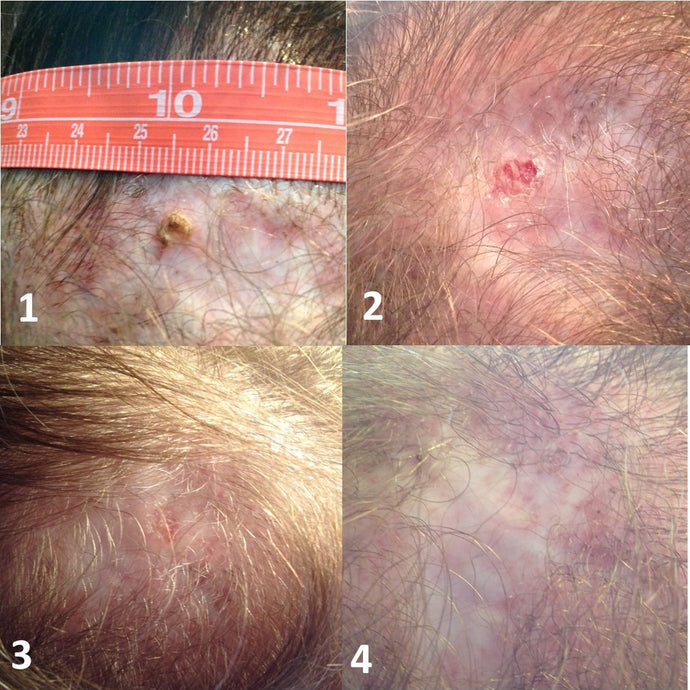 Frankincense and Skin Growths That Could Possibly Be Cancerous