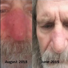What is Rosacea and Why Do I Have It?