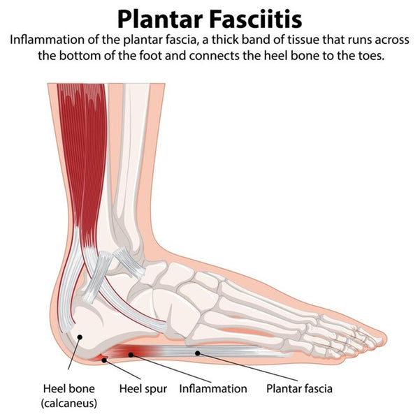 Plantar Fasciitis: 3 Known Solutions